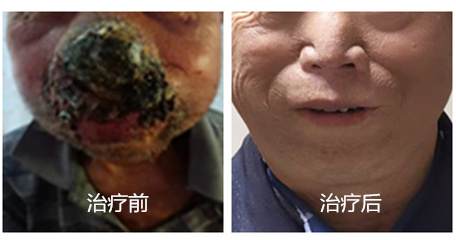 绝望与重生!青岛市中心医院成功救治鼻腔nk/t细胞淋巴瘤患者