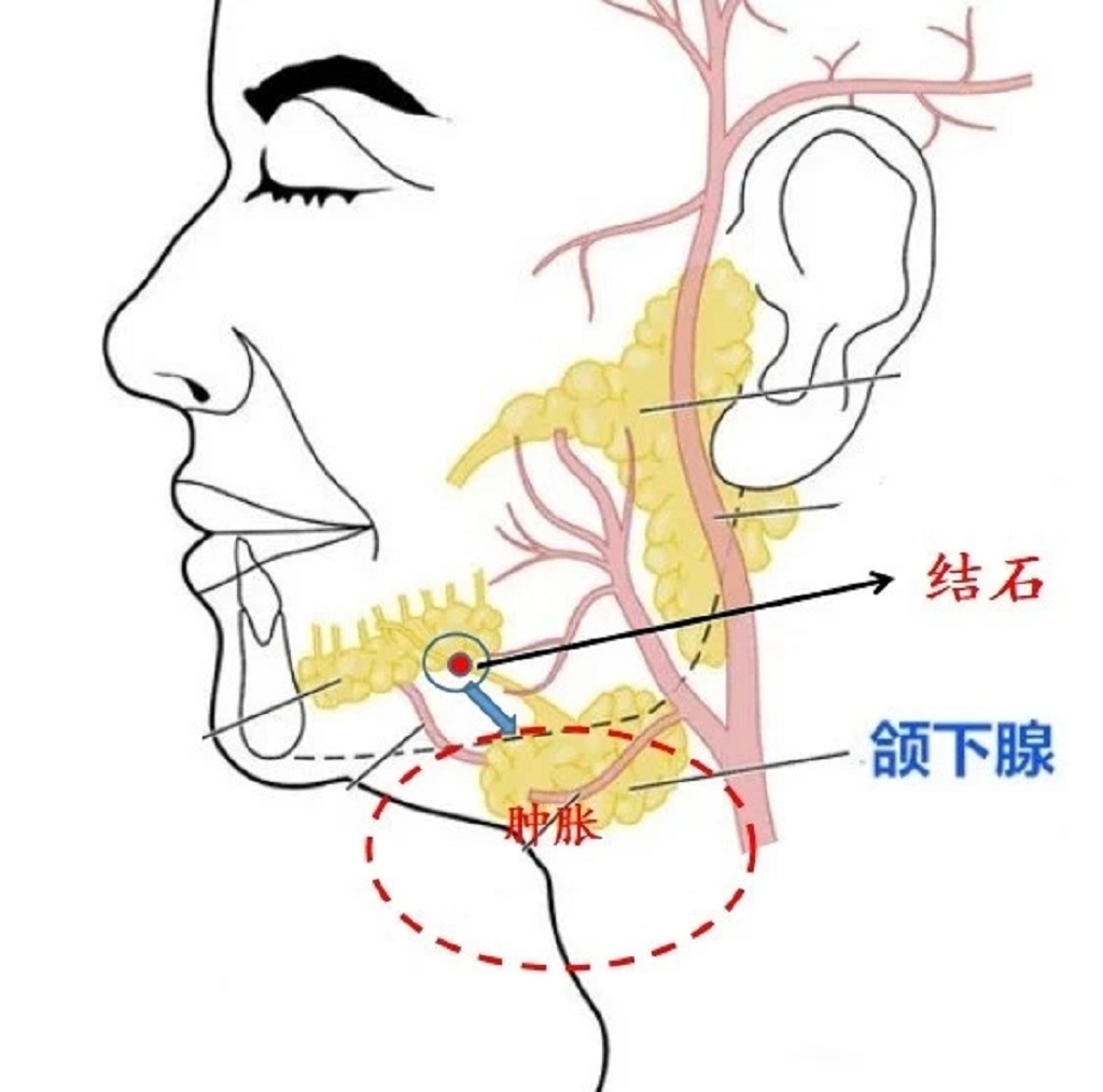 下颌下腺位置图片图片
